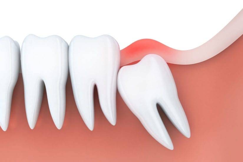 Impacted Wisdom Tooth Diagram