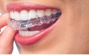 Close Up of Mouth Inserting Clear Braces