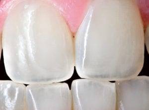 eroding translucent tooth